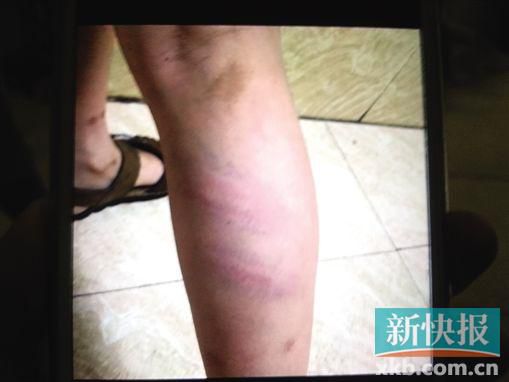 小宇腿部有明顯瘀痕。 翻拍自家屬手機(jī) 小宇腿部有明顯瘀痕。 翻拍自家屬手機(jī)