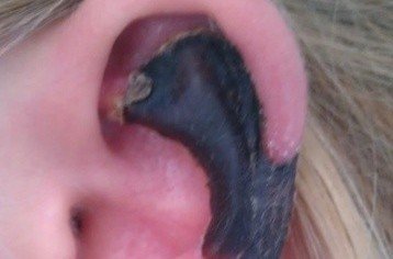 荷蘭女子旅游途中被蜘蛛咬,耳軟骨溶解變黑。 荷蘭女子旅游途中被蜘蛛咬,耳軟骨溶解變黑。