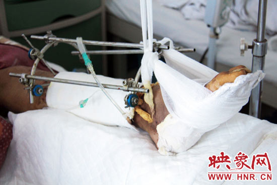 楊偉峰的左腿受傷較重 楊偉峰的左腿受傷較重