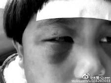 6月2日,網曝渭南市臨渭區一不滿5歲的女童遭奶奶毆打,眼圈青腫,引起網友關注,但孩子父母和爺爺均稱是摔倒導致。相關部門介入調查發現確為奶奶毆打所致,鑒于其身體原因已進行批評教育。