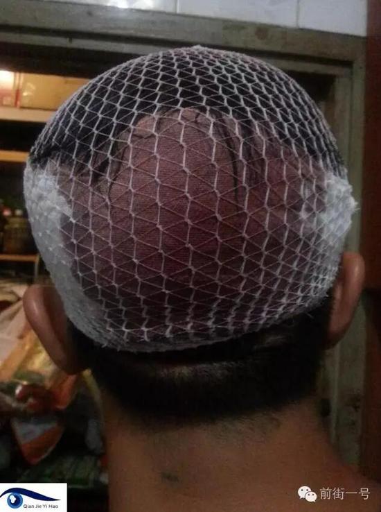 李律師受傷后縫合三針。 李律師受傷后縫合三針。