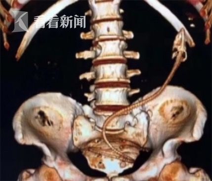 黃鱔從肛門鉆進肚子 男子被送醫不愿多談事情經過