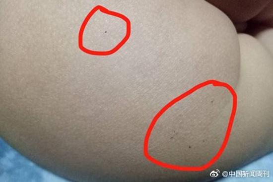 據多名紅黃藍(新天地分園)家長反映,孩子腿部、屁股、腋下出現針眼。 據多名紅黃藍(新天地分園)家長反映,孩子腿部、屁股、腋下出現針眼。