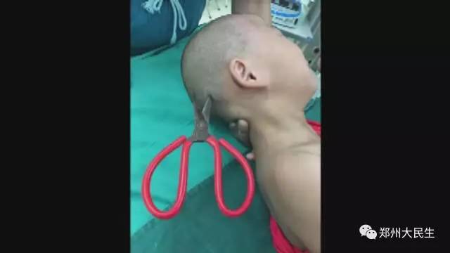 剪刀插入6歲女孩頭部 圖片讓人心驚膽戰 剪刀插入6歲女孩頭部 圖片讓人心驚膽戰