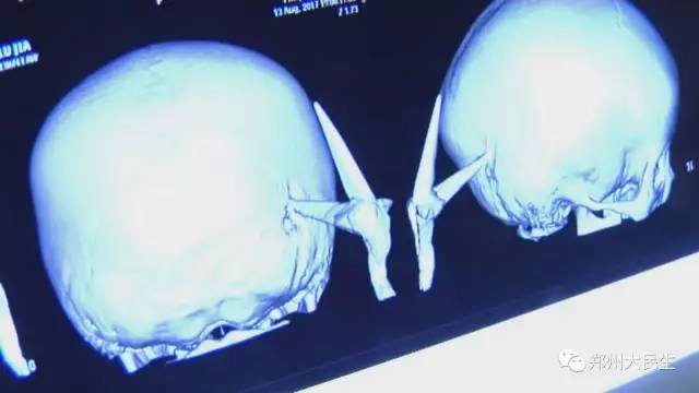 剪刀插入6歲女孩頭部 圖片讓人心驚膽戰 剪刀插入6歲女孩頭部 圖片讓人心驚膽戰