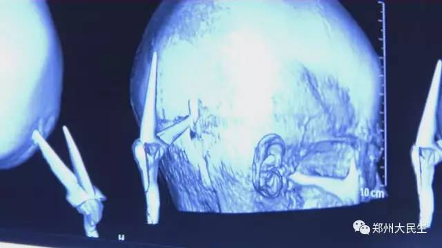 剪刀插入6歲女孩頭部 圖片讓人心驚膽戰 剪刀插入6歲女孩頭部 圖片讓人心驚膽戰