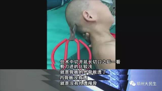 剪刀插入6歲女孩頭部 圖片讓人心驚膽戰 剪刀插入6歲女孩頭部 圖片讓人心驚膽戰