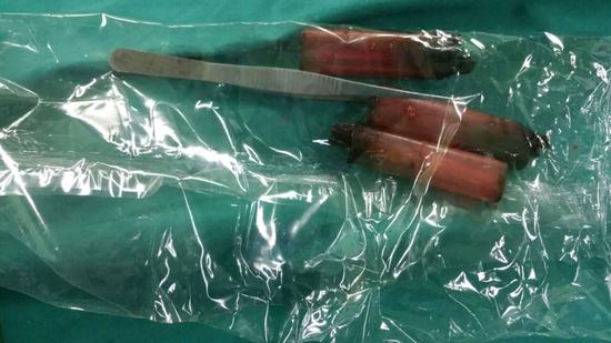 醫生從華先生胃里取出的鑷子和打火機