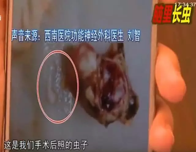 少女大腦皮層萎縮 醫生從她腦子里捉出5厘米蟲子 少女大腦皮層萎縮 醫生從她腦子里捉出5厘米蟲子