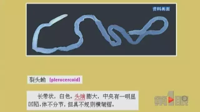 少女大腦皮層萎縮 醫生從她腦子里捉出5厘米蟲子 少女大腦皮層萎縮 醫生從她腦子里捉出5厘米蟲子