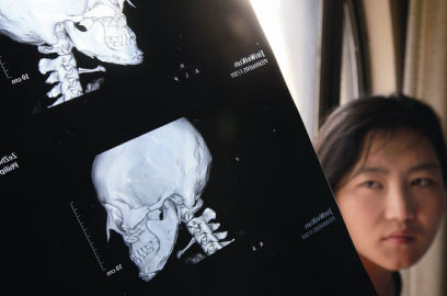 國內(nèi)醫(yī)院CT顯示,如今靳魏坤的鼻子假體是歪的,連下巴也是歪的 國內(nèi)醫(yī)院CT顯示,如今靳魏坤的鼻子假體是歪的,連下巴也是歪的