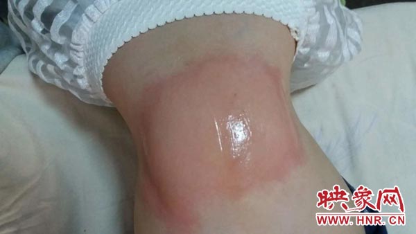 緯三路小學一名學生身上出現的不適癥狀 緯三路小學一名學生身上出現的不適癥狀