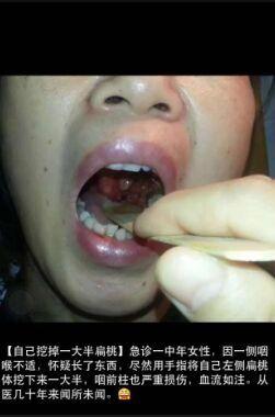 圖片來自市三醫院耳鼻喉科醫生朋友圈 圖片來自市三醫院耳鼻喉科醫生朋友圈