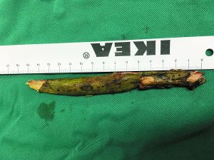 插入男子腦內的樹枝。