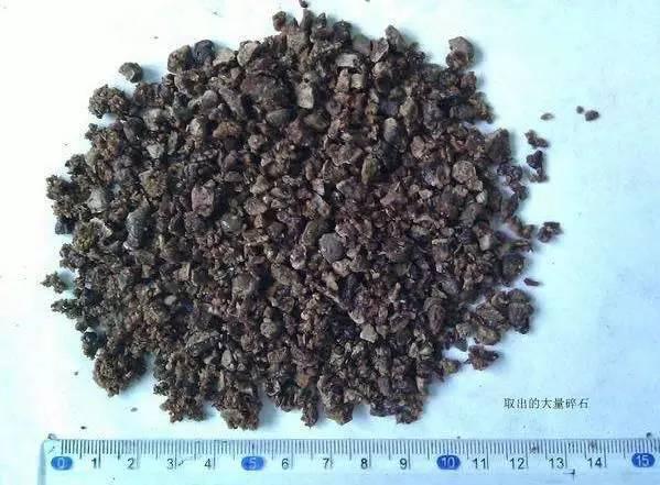 55歲大爺因愛吃豆腐 體內(nèi)取出420顆結(jié)石 55歲大爺因愛吃豆腐 體內(nèi)取出420顆結(jié)石