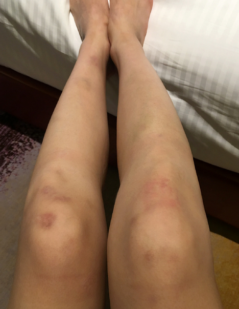 沈夢(mèng)辰曬傷腿 沈夢(mèng)辰曬傷腿